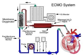 فيديو- تقنية الـ ECMO لإنقاذ حياة أطفال بعيوب خلقية في المقاصد